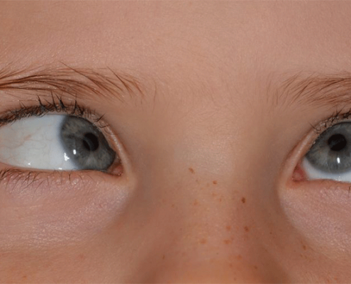 Crossed Eye disease