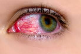 conjunctivitis-red-eyes