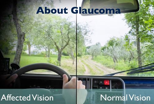 glaucoma treatment