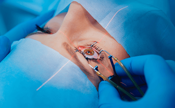 cataract-surgery cataract-surgery