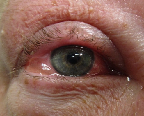 eye with Allergic conjunctivitis disease