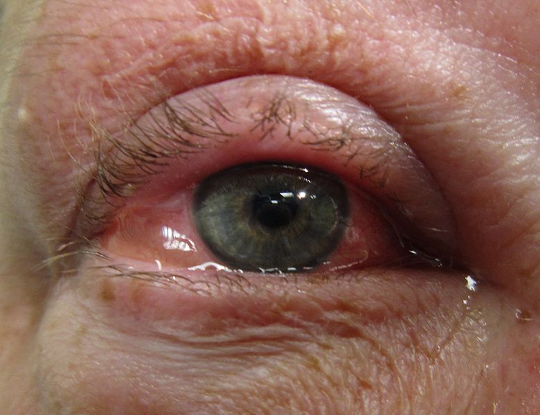 EYE Q INDIA Conjunctivitis Symptoms Treatment And Eye Care