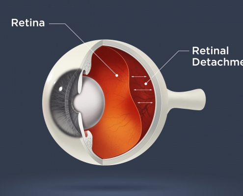 Retina detachment Treatment