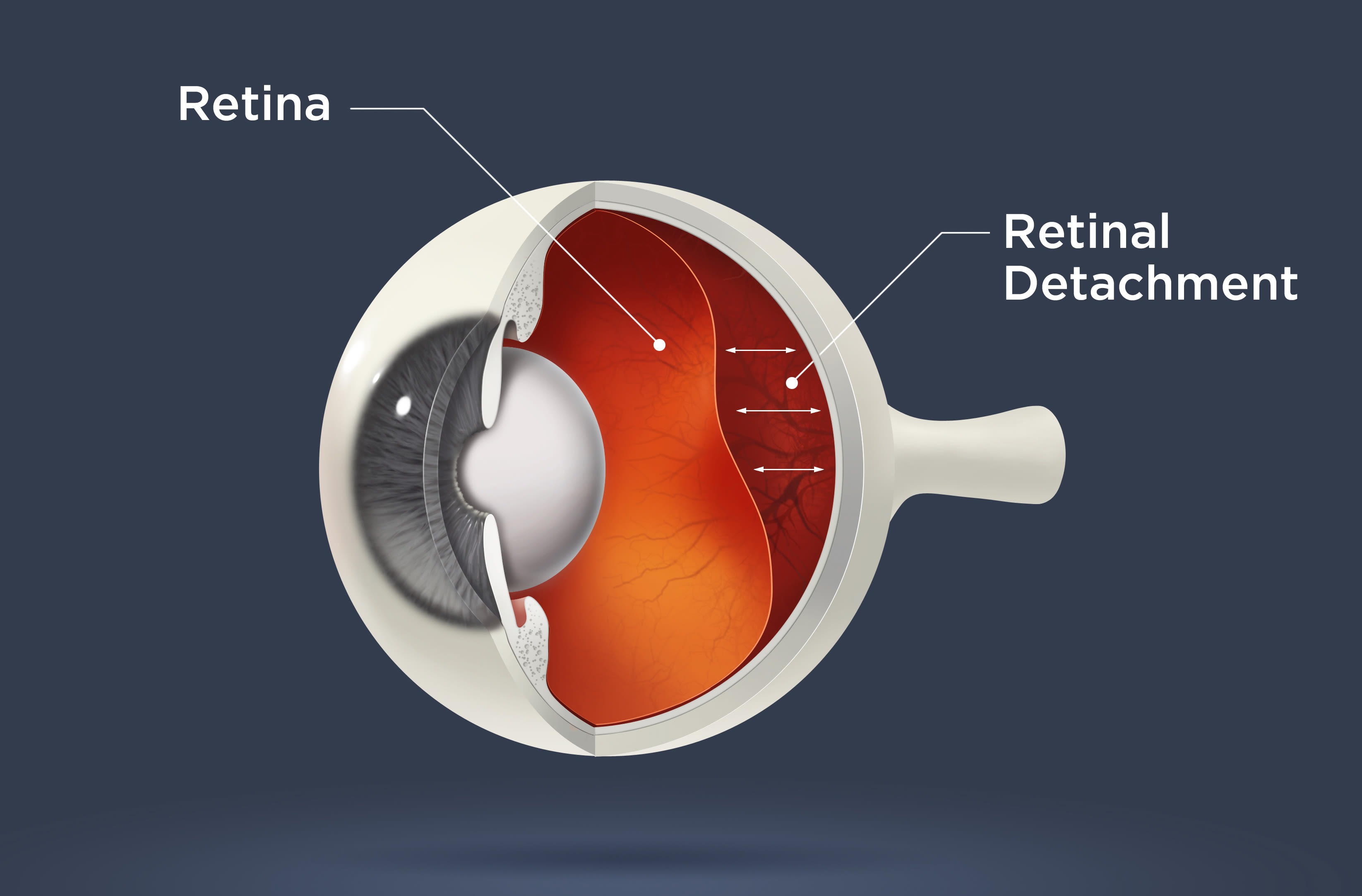 Retina detachment Treatment