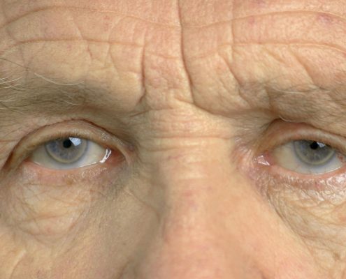 Old Man second eye cataract treatment