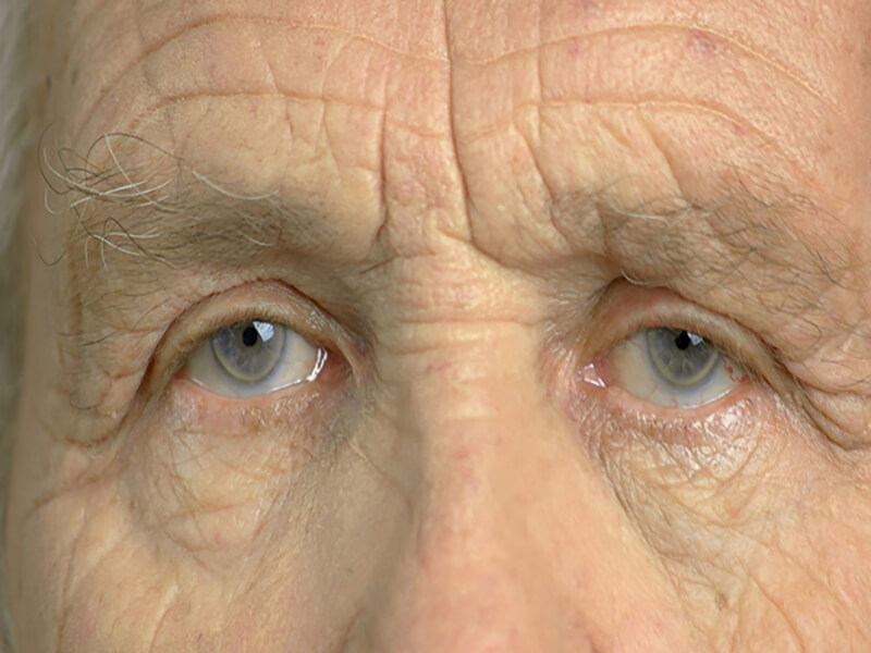 Cataract