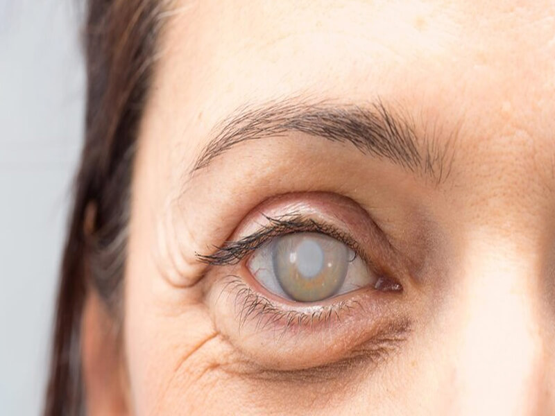 Do's And Don'ts Before Cataract Surgery