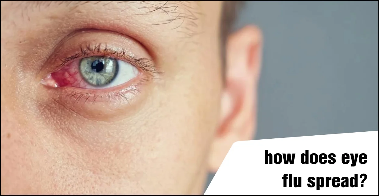 How Does Eye Flu Spread