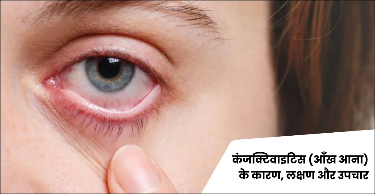 कंजंक्टिवाइटिस (आंख आना) के कारण