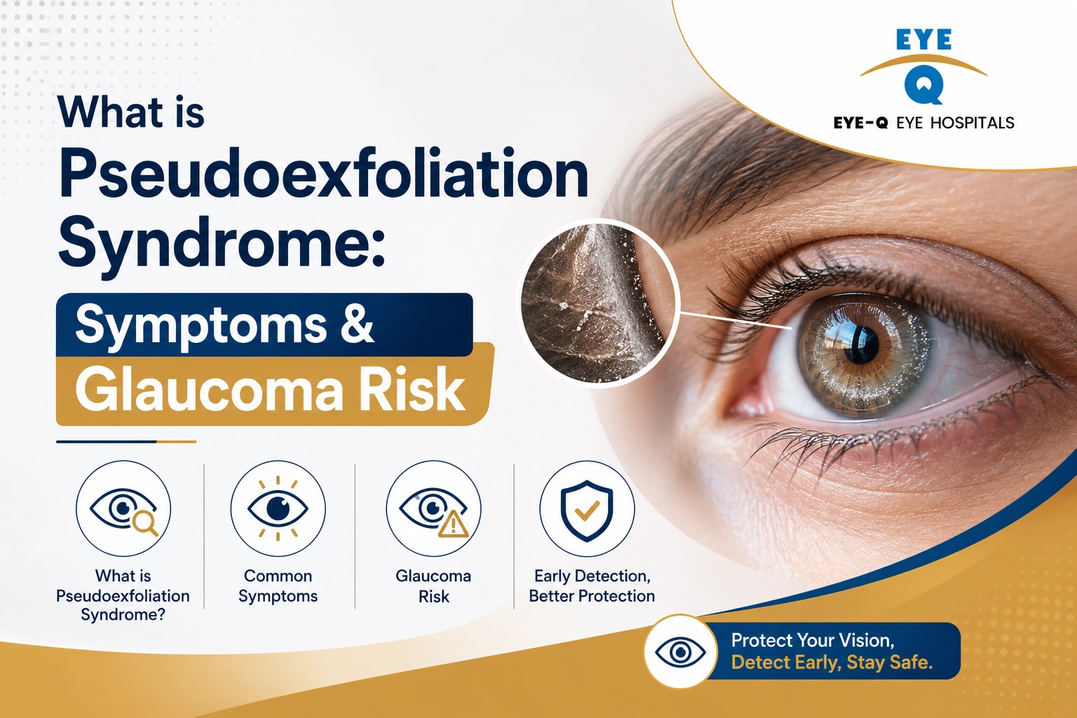 What is Pseudoexfoliation Syndrome